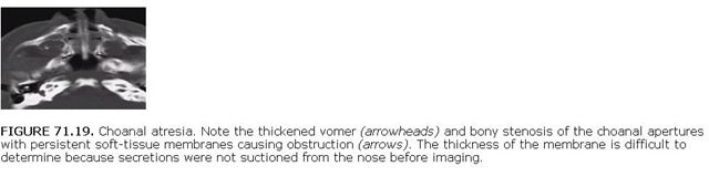 choanal atresia