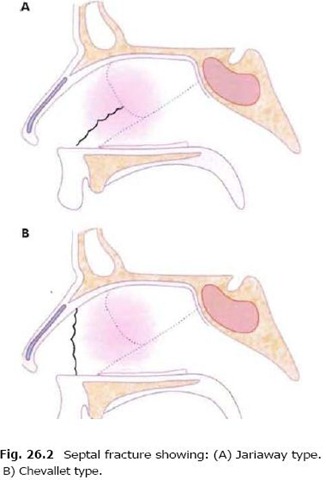 septal fracture