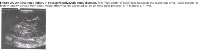 PCKD ECHOGENECITY
