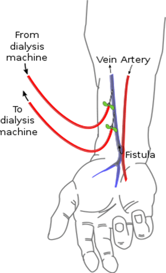 220px-Radiocephalic_fistula_svg